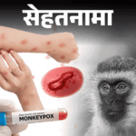 Africa Monkeypox Outbreak Symptoms Explained; Transmission And Treatment | Sehatnama- Monkeypox outbreak spreading in African countries: WHO is worried, may declare global emergency, know symptoms and prevention