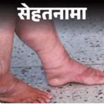 Filariasis Symptoms; Hathi Paon (Elephantiasis) Causes Treatment | Sehatnama- 74 crore Indians are at risk of filariasis: 3.1 crore people infected, know its symptoms from the doctor, how to protect yourself.