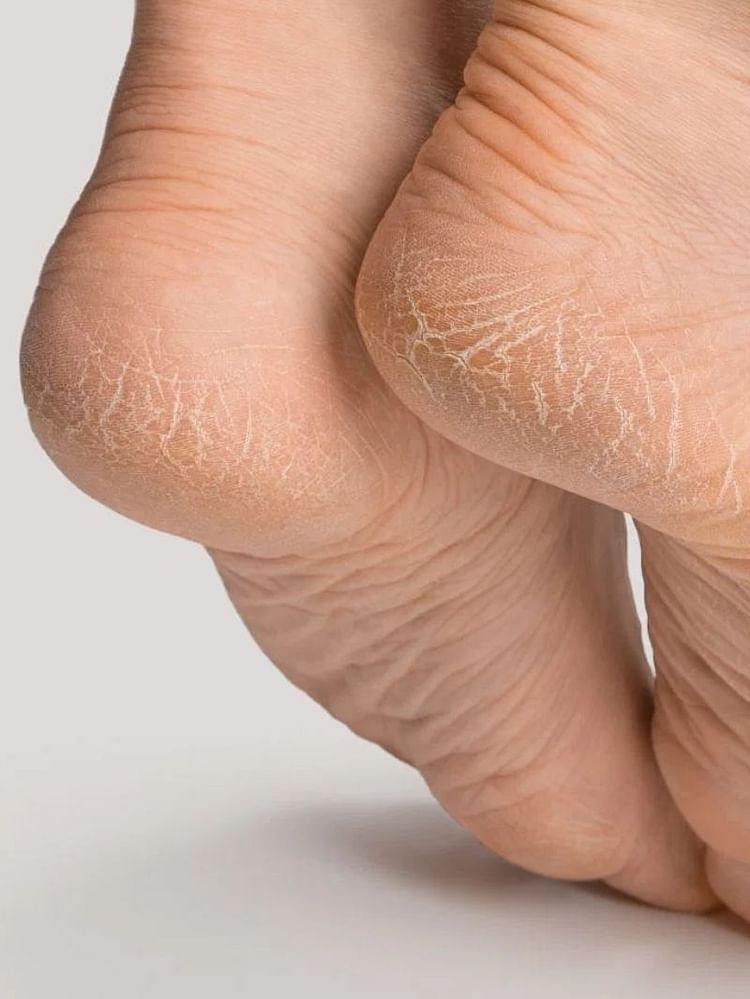 These remedies will provide relief from cracked heels