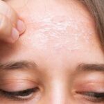 Winter Skin Care Tips Know How To Get Dry Skin On Forehead Remove Cracks - Amar Ujala Hindi News Live