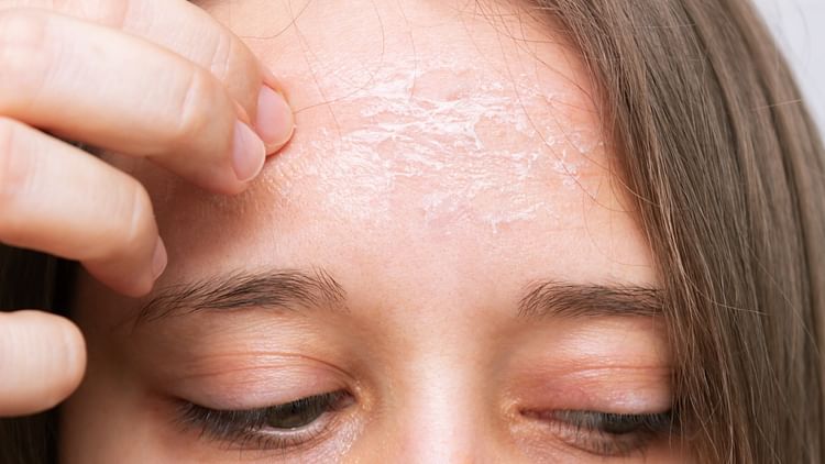 Winter Skin Care Tips Know How To Get Dry Skin On Forehead Remove Cracks - Amar Ujala Hindi News Live