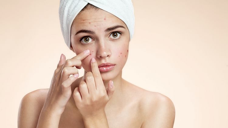 Skin Care Tips: If you are troubled by acne then try these remedies once, you will get relief in a week.